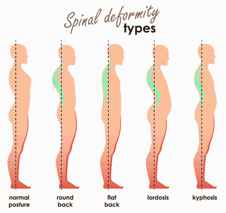 Lumbar lordosis or hyperlordosis Back Care Clinic