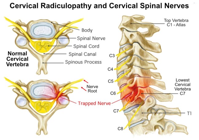 Cervical Spine Nerve Damage Pinched Nerve Dynamic Spine Cervical Spine Nerve Damage Pinched Nerve Dynamic Spine