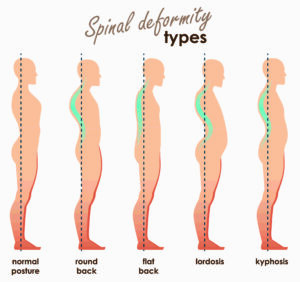 Lumbar Lordosis Or Hyperlordosis Back Care Clinic