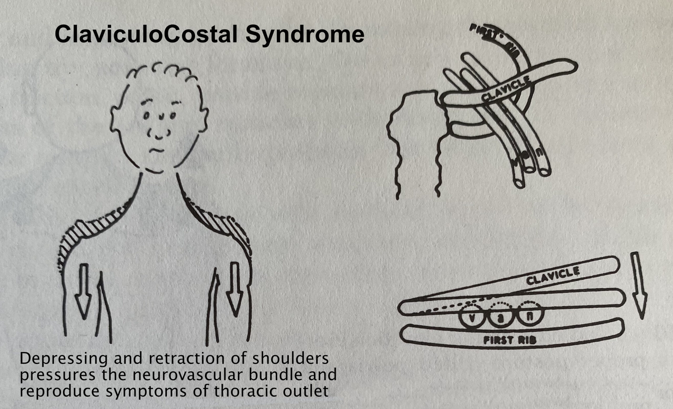 Thoracic Outlet Syndrome (TOS) and other similar conditions - Back