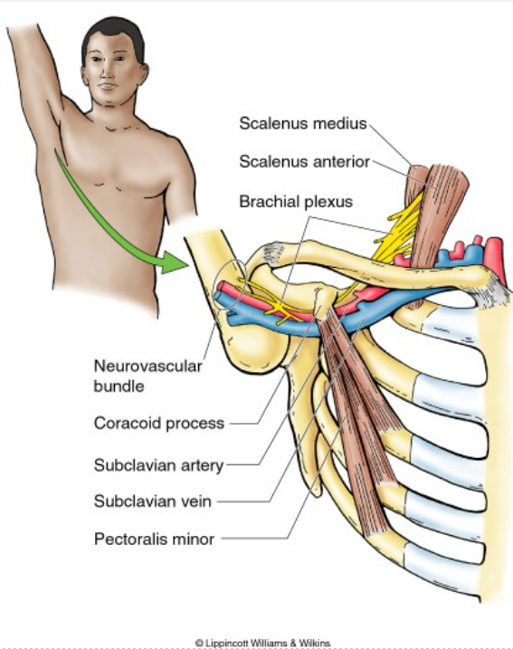 Thoracic Outlet Syndrome (TOS) and other similar conditions - Back Care  Clinic