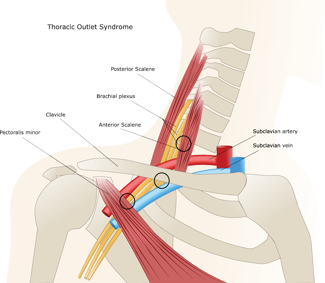 Thoracic Outlet Syndrome (TOS) and other similar conditions - Back Care  Clinic